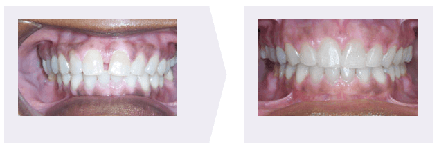 overbite correct spaced braces orthodontics trimark