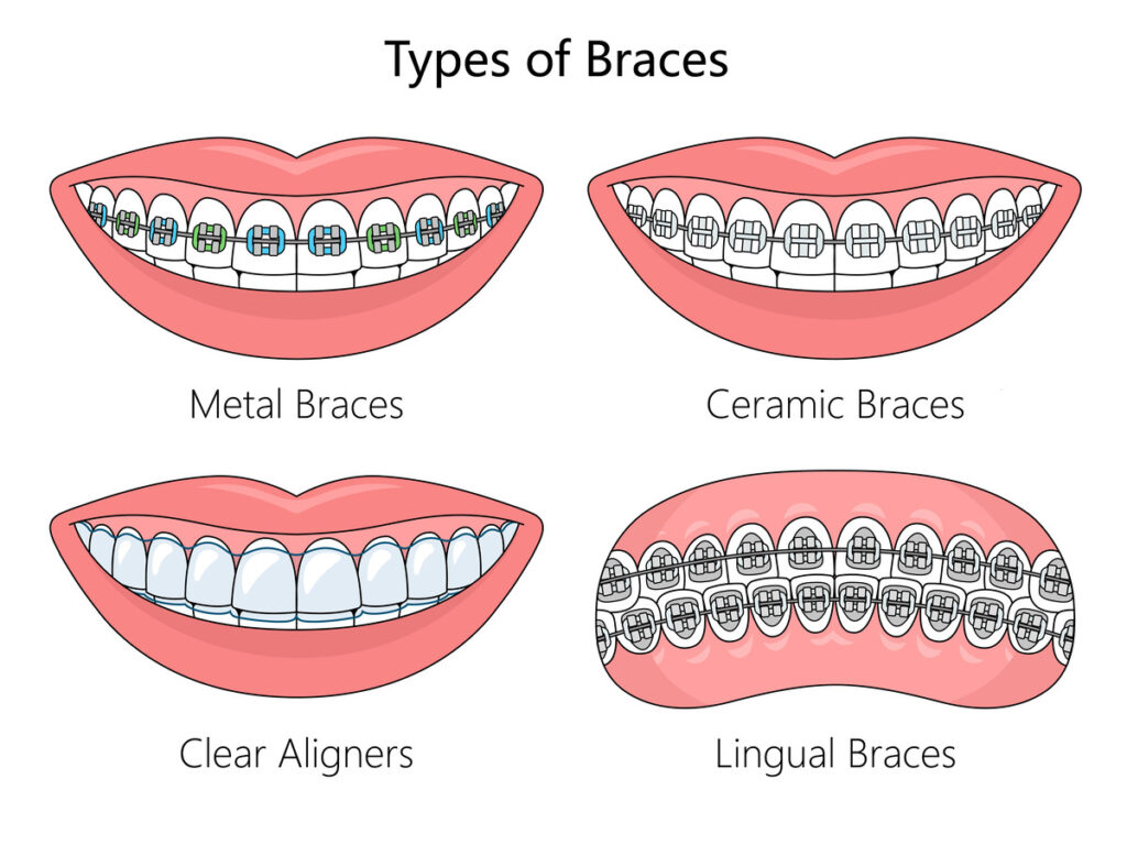 types of braces